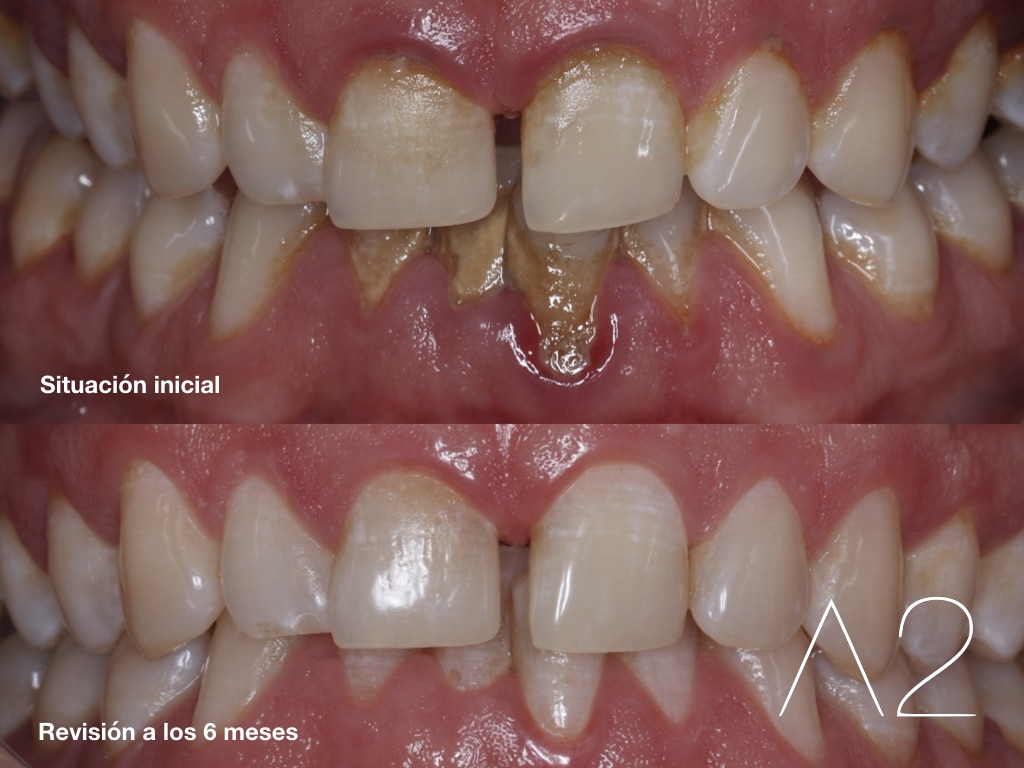 tooth loss periodontal desease