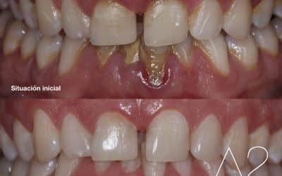 Caída de dientes en adultos: ¿cómo prevenir la pérdida dental por enfermedad periodontal?