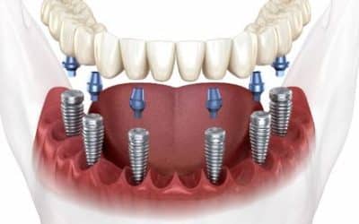 Implantes dentales All-on-4 y All-on-6: dientes fijos en un solo día
