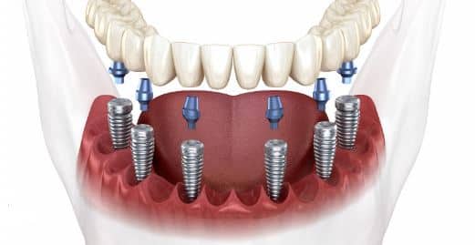 all-on-6-implantes-dentales