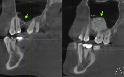 Injerto de hueso dental: ¿Duele? ¿Cuánto tarda en cicatrizar? Todo lo que necesitas saber